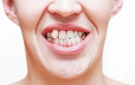 Crooked Tooth Treatment Cheltenham