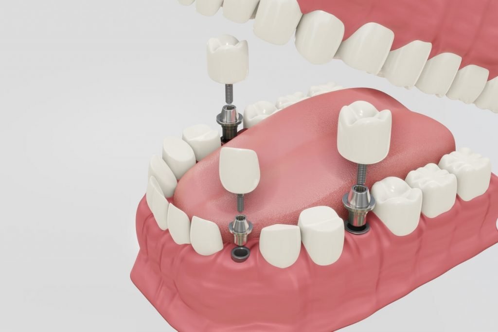 Dental Implant Care