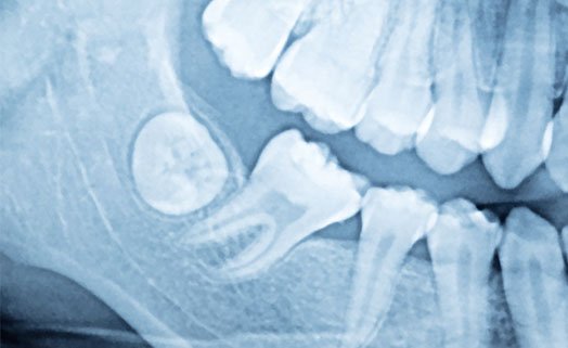 Wisdom Tooth Treatment Cheltenham