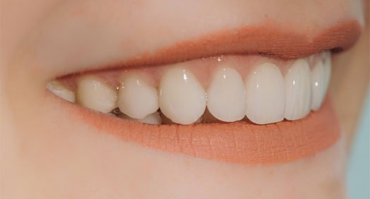 Fixing Porcelain Veneers Cheltenham