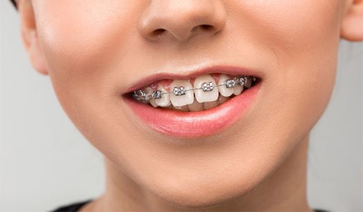 How Braces Align Teeth Cheltenham