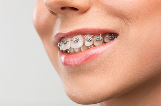 Orthodontics Cheltenham