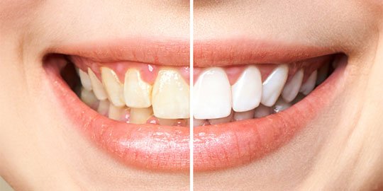 Teeth Whitening Blurb Cheltenham