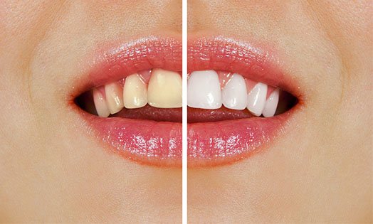 Teeth Whitening Cheltenham