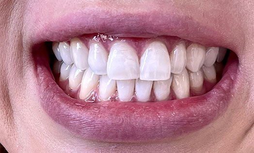 teeth whitening cheltenham