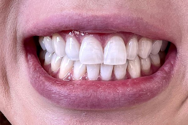 teeth whiteninge after case 1