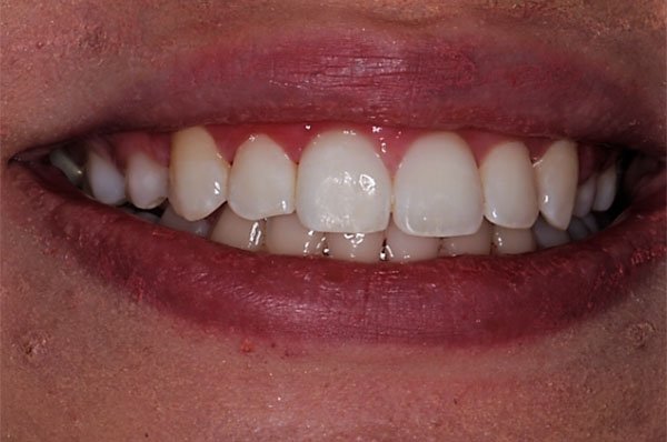 fluorosis after case 1 dentist cheltenham