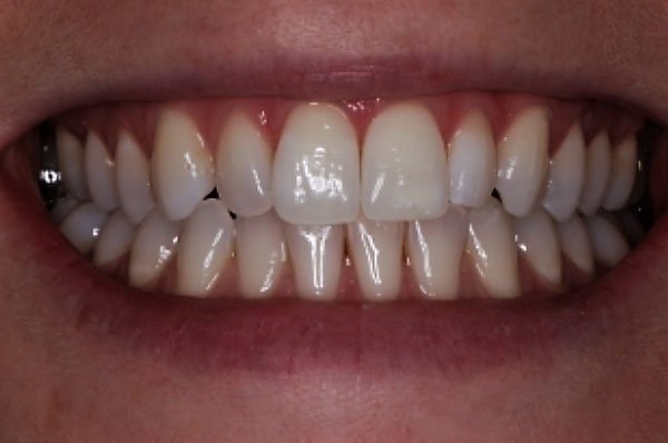 fluorosis after case 2 dentist cheltenham