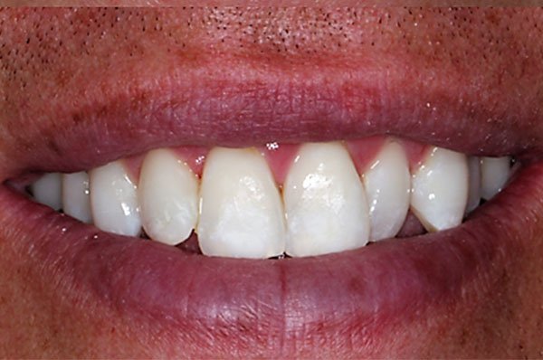 fluorosis after case 3 dentist cheltenham