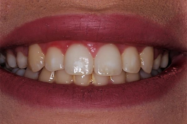 fluorosis before case 1 dentist cheltenham