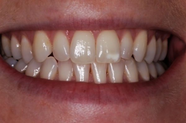fluorosis before case 2 dentist cheltenham