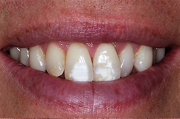 fluorosis before case 3 dentist cheltenham