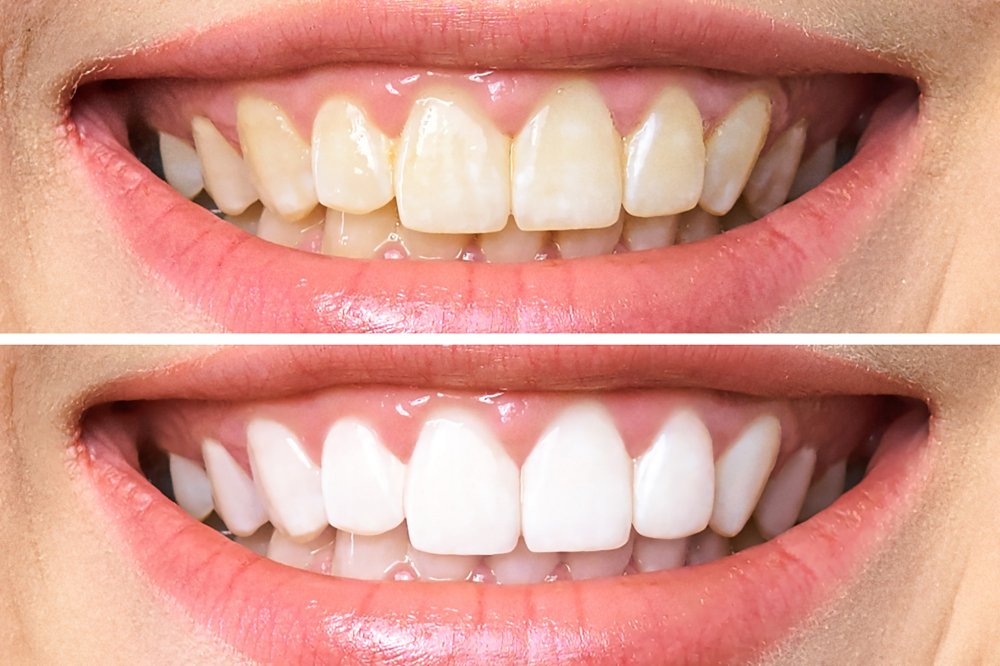 teeth whitening cheltenham