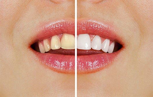 Zoom-Whitening-Cheltenham