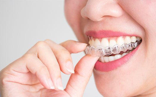 how does invisalign treatment work cheltenham