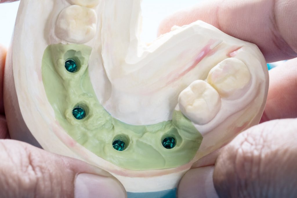 dental implants in cheltenham should you shop around