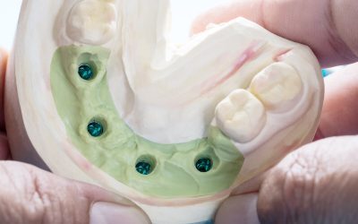 Dental Implants in Cheltenham: Should You Shop Around?