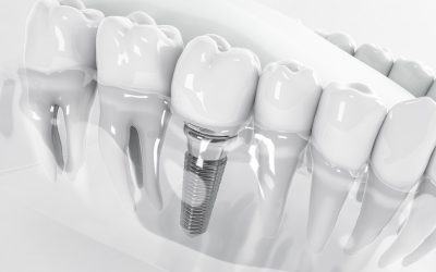 Are Dental Implants The Long-term Solutions for Lost Teeth?