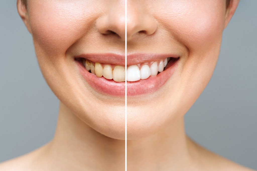 thinking about tooth whitening here are a few things to consider