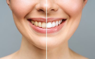 Thinking About Tooth Whitening? Here Are A Few Things to Consider