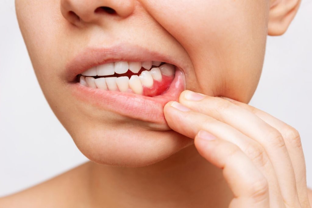 7 tips on avoiding periodontal disease dentist on warrigal