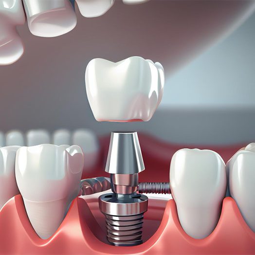 dental implants cheltenham