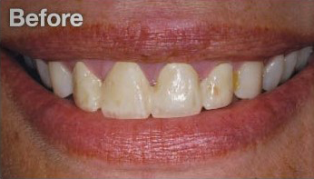 porcelain-venners-before-case-1-dentist-warrigal