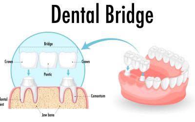 Dental Bridges: Types, Cost and How They Work