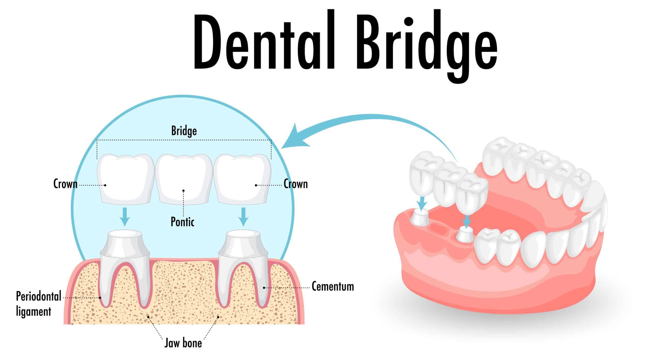 Dental Bridges Types, Cost and How They Work