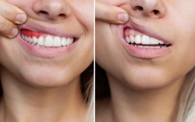 Gum Disease and Breast Cancer: What the Latest Research Reveals About Oral Health Risks