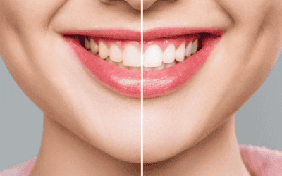 Teeth Whitening in Cheltenham: A Guide to a Brighter Smile
