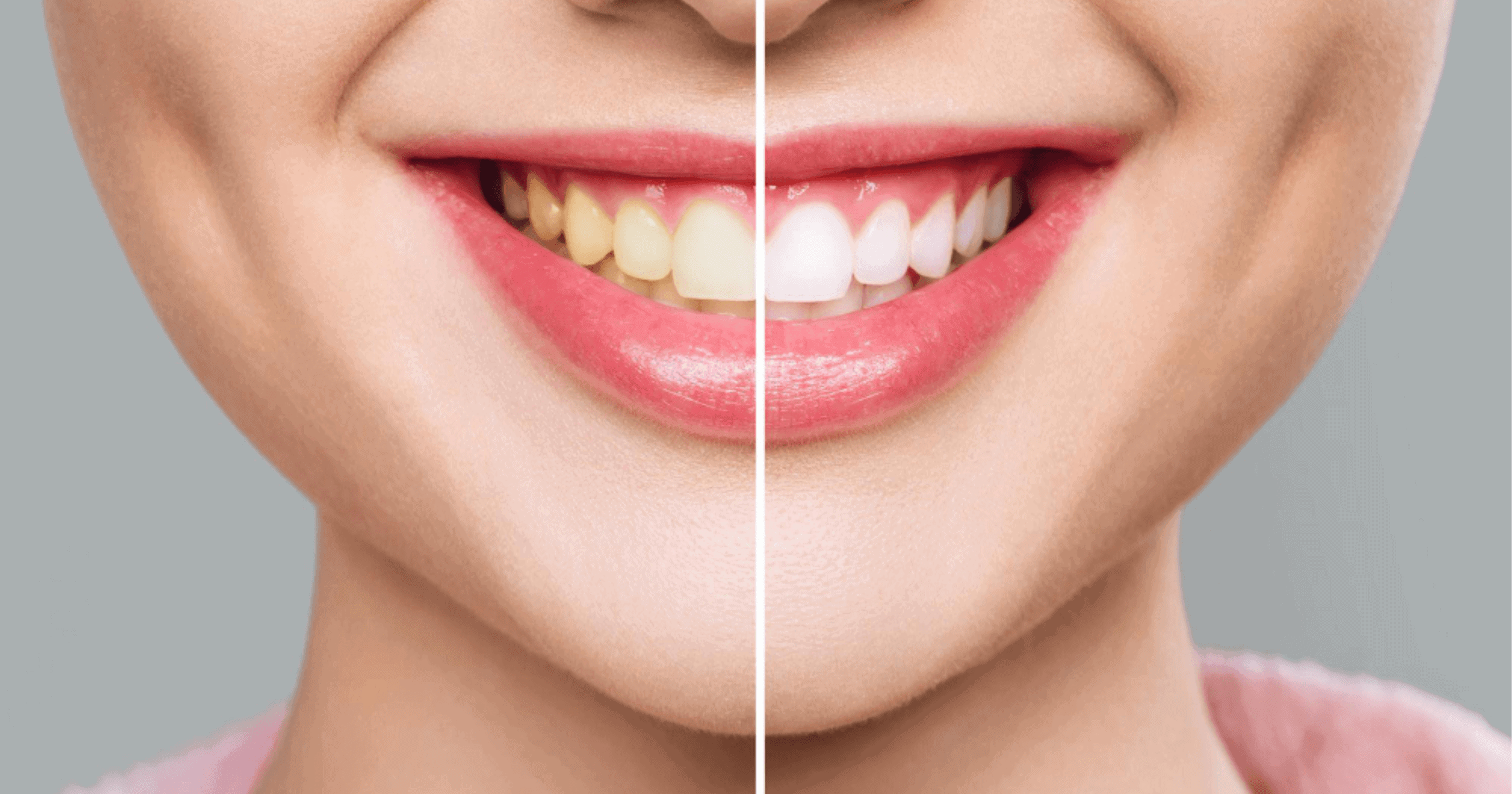 Teeth Whitening in Cheltenham_ A Guide to a Brighter Smile